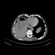 Liver abscess, large, punction, pneumothorax: CT - Computed tomography